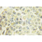 AF3197 at 1/100 staining Human breast cancer tissue by IHC-P. The sample was formaldehyde fixed and a heat mediated antigen retrieval step in citrate buffer was performed. The sample was then blocked and incubated with the antibody for 1.5 hours at 22¡ãC. An HRP conjugated goat anti-rabbit antibody was used as the secondary