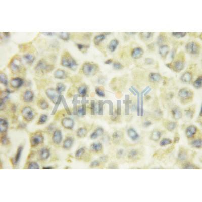 AF3197 at 1/100 staining Human breast cancer tissue by IHC-P. The sample was formaldehyde fixed and a heat mediated antigen retrieval step in citrate buffer was performed. The sample was then blocked and incubated with the antibody for 1.5 hours at 22¡ãC. An HRP conjugated goat anti-rabbit antibody was used as the secondary