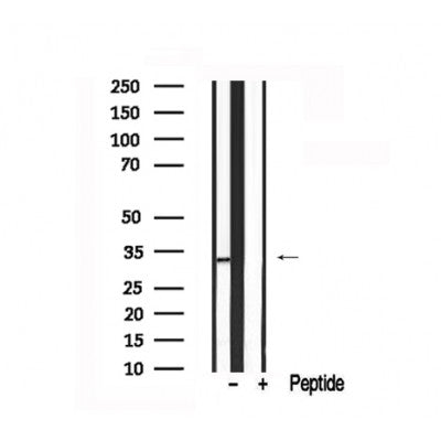 AF7675 at 1/100 staining Human urothelial cancer tissue by IHC-P. The sample was formaldehyde fixed and a heat mediated antigen retrieval step in citrate buffer was performed. The sample was then blocked and incubated with the antibody for 1.5 hours at 22¡ãC. An HRP conjugated goat anti-rabbit antibody was used as the secondary