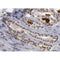 AF0228 at 1/200 staining human lung cancer tissue sections by IHC-P. The tissue was formaldehyde fixed and a heat mediated antigen retrieval step in citrate buffer was performed. The tissue was then blocked and incubated with the antibody for 1.5 hours at 22¡ãC. An HRP conjugated goat anti-rabbit antibody was used as the secondary