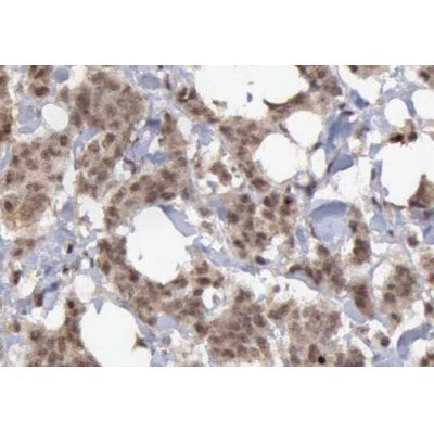 AF0229 at 1/200 staining human Breast cancer tissue sections by IHC-P. The tissue was formaldehyde fixed and a heat mediated antigen retrieval step in citrate buffer was performed. The tissue was then blocked and incubated with the antibody for 1.5 hours at 22¡ãC. An HRP conjugated goat anti-rabbit antibody was used as the secondary