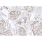 AF0230 at 1/200 staining human Breast cancer tissue sections by IHC-P. The tissue was formaldehyde fixed and a heat mediated antigen retrieval step in citrate buffer was performed. The tissue was then blocked and incubated with the antibody for 1.5 hours at 22¡ãC. An HRP conjugated goat anti-rabbit antibody was used as the secondary