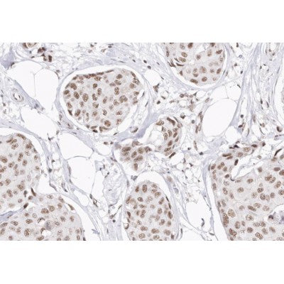 AF0230 at 1/200 staining human Breast cancer tissue sections by IHC-P. The tissue was formaldehyde fixed and a heat mediated antigen retrieval step in citrate buffer was performed. The tissue was then blocked and incubated with the antibody for 1.5 hours at 22¡ãC. An HRP conjugated goat anti-rabbit antibody was used as the secondary