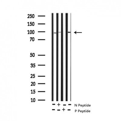 AF3340 at 1/100 staining human Stomach cancer tissue sections by IHC-P. The tissue was formaldehyde fixed and a heat mediated antigen retrieval step in citrate buffer was performed. The tissue was then blocked and incubated with the antibody for 1.5 hours at 22¡ãC. An HRP conjugated goat anti-rabbit antibody was used as the secondary