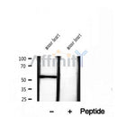 DF12054 at 1/100 staining Human breast cancer tissue by IHC-P. The sample was formaldehyde fixed and a heat mediated antigen retrieval step in citrate buffer was performed. The sample was then blocked and incubated with the antibody for 1.5 hours at 22¡ãC. An HRP conjugated goat anti-rabbit antibody was used as the secondary