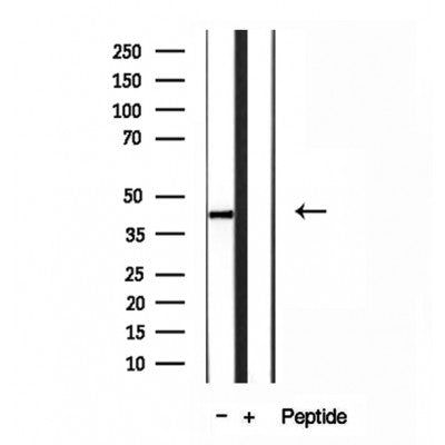 DF12065 at 1/100 staining Human brain cancer tissue by IHC-P. The sample was formaldehyde fixed and a heat mediated antigen retrieval step in citrate buffer was performed. The sample was then blocked and incubated with the antibody for 1.5 hours at 22¡ãC. An HRP conjugated goat anti-rabbit antibody was used as the secondary