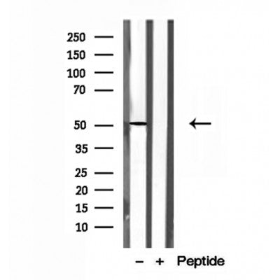 DF12126 at 1/100 staining Human breast cancer tissue by IHC-P. The sample was formaldehyde fixed and a heat mediated antigen retrieval step in citrate buffer was performed. The sample was then blocked and incubated with the antibody for 1.5 hours at 22¡ãC. An HRP conjugated goat anti-rabbit antibody was used as the secondary