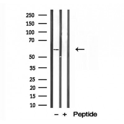DF12131 at 1/100 staining Human breast cancer tissue by IHC-P. The sample was formaldehyde fixed and a heat mediated antigen retrieval step in citrate buffer was performed. The sample was then blocked and incubated with the antibody for 1.5 hours at 22¡ãC. An HRP conjugated goat anti-rabbit antibody was used as the secondary