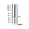 DF12135 at 1/100 staining Human liver cancer tissue by IHC-P. The sample was formaldehyde fixed and a heat mediated antigen retrieval step in citrate buffer was performed. The sample was then blocked and incubated with the antibody for 1.5 hours at 22¡ãC. An HRP conjugated goat anti-rabbit antibody was used as the secondary