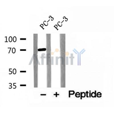 DF12154 at 1/100 staining Human breast cancer tissue by IHC-P. The sample was formaldehyde fixed and a heat mediated antigen retrieval step in citrate buffer was performed. The sample was then blocked and incubated with the antibody for 1.5 hours at 22¡ãC. An HRP conjugated goat anti-rabbit antibody was used as the secondary