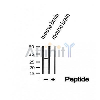 DF12200 at 1/100 staining Human liver cancer tissue by IHC-P. The sample was formaldehyde fixed and a heat mediated antigen retrieval step in citrate buffer was performed. The sample was then blocked and incubated with the antibody for 1.5 hours at 22¡ãC. An HRP conjugated goat anti-rabbit antibody was used as the secondary