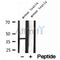 DF12213 at 1/100 staining Human lymph cancer tissue by IHC-P. The sample was formaldehyde fixed and a heat mediated antigen retrieval step in citrate buffer was performed. The sample was then blocked and incubated with the antibody for 1.5 hours at 22¡ãC. An HRP conjugated goat anti-rabbit antibody was used as the secondary