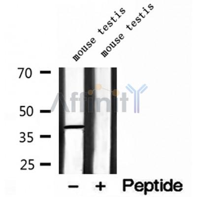 DF12213 at 1/100 staining Human lymph cancer tissue by IHC-P. The sample was formaldehyde fixed and a heat mediated antigen retrieval step in citrate buffer was performed. The sample was then blocked and incubated with the antibody for 1.5 hours at 22¡ãC. An HRP conjugated goat anti-rabbit antibody was used as the secondary