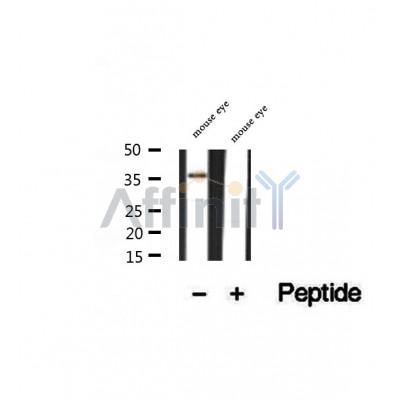 DF12223 at 1/100 staining Human lymph cancer tissue by IHC-P. The sample was formaldehyde fixed and a heat mediated antigen retrieval step in citrate buffer was performed. The sample was then blocked and incubated with the antibody for 1.5 hours at 22¡ãC. An HRP conjugated goat anti-rabbit antibody was used as the secondary