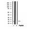 DF12230 at 1/100 staining Human lymph cancer tissue by IHC-P. The sample was formaldehyde fixed and a heat mediated antigen retrieval step in citrate buffer was performed. The sample was then blocked and incubated with the antibody for 1.5 hours at 22¡ãC. An HRP conjugated goat anti-rabbit antibody was used as the secondary