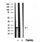 DF12236 at 1/100 staining Human lymph cancer tissue by IHC-P. The sample was formaldehyde fixed and a heat mediated antigen retrieval step in citrate buffer was performed. The sample was then blocked and incubated with the antibody for 1.5 hours at 22¡ãC. An HRP conjugated goat anti-rabbit antibody was used as the secondary