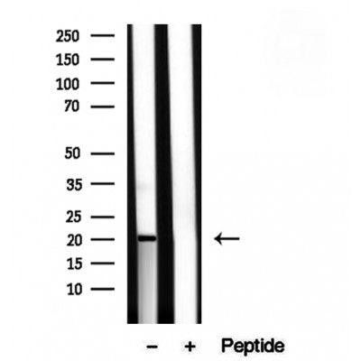 DF12236 at 1/100 staining Human lymph cancer tissue by IHC-P. The sample was formaldehyde fixed and a heat mediated antigen retrieval step in citrate buffer was performed. The sample was then blocked and incubated with the antibody for 1.5 hours at 22¡ãC. An HRP conjugated goat anti-rabbit antibody was used as the secondary