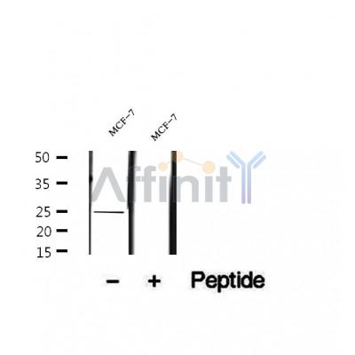 DF12240 at 1/100 staining Human lymph cancer tissue by IHC-P. The sample was formaldehyde fixed and a heat mediated antigen retrieval step in citrate buffer was performed. The sample was then blocked and incubated with the antibody for 1.5 hours at 22¡ãC. An HRP conjugated goat anti-rabbit antibody was used as the secondary