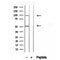 DF12244 at 1/100 staining Human lymph cancer tissue by IHC-P. The sample was formaldehyde fixed and a heat mediated antigen retrieval step in citrate buffer was performed. The sample was then blocked and incubated with the antibody for 1.5 hours at 22¡ãC. An HRP conjugated goat anti-rabbit antibody was used as the secondary