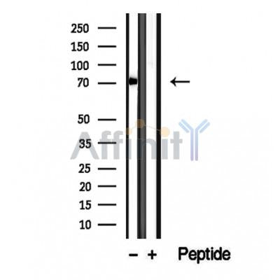 DF12251 at 1/100 staining Human lymph cancer tissue by IHC-P. The sample was formaldehyde fixed and a heat mediated antigen retrieval step in citrate buffer was performed. The sample was then blocked and incubated with the antibody for 1.5 hours at 22¡ãC. An HRP conjugated goat anti-rabbit antibody was used as the secondary