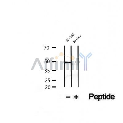 DF12273 at 1/100 staining Human lymph cancer tissue by IHC-P. The sample was formaldehyde fixed and a heat mediated antigen retrieval step in citrate buffer was performed. The sample was then blocked and incubated with the antibody for 1.5 hours at 22¡ãC. An HRP conjugated goat anti-rabbit antibody was used as the secondary
