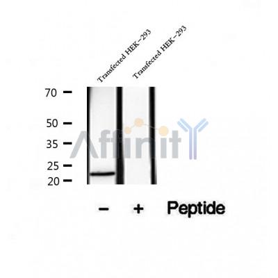 DF12276 at 1/100 staining Human lymph cancer tissue by IHC-P. The sample was formaldehyde fixed and a heat mediated antigen retrieval step in citrate buffer was performed. The sample was then blocked and incubated with the antibody for 1.5 hours at 22¡ãC. An HRP conjugated goat anti-rabbit antibody was used as the secondary