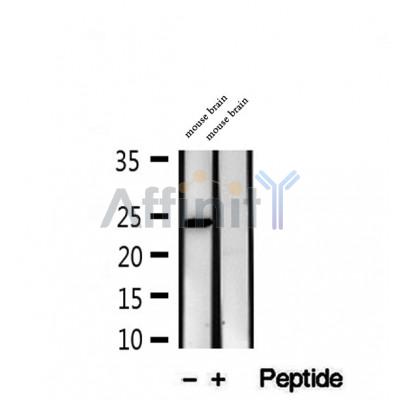 DF12288 at 1/100 staining Human breast cancer tissue by IHC-P. The sample was formaldehyde fixed and a heat mediated antigen retrieval step in citrate buffer was performed. The sample was then blocked and incubated with the antibody for 1.5 hours at 22¡ãC. An HRP conjugated goat anti-rabbit antibody was used as the secondary