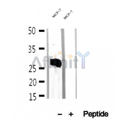 DF12290 at 1/100 staining Human lung cancer tissue by IHC-P. The sample was formaldehyde fixed and a heat mediated antigen retrieval step in citrate buffer was performed. The sample was then blocked and incubated with the antibody for 1.5 hours at 22¡ãC. An HRP conjugated goat anti-rabbit antibody was used as the secondary