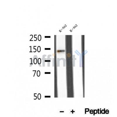 DF12296 at 1/100 staining Human breast cancer tissue by IHC-P. The sample was formaldehyde fixed and a heat mediated antigen retrieval step in citrate buffer was performed. The sample was then blocked and incubated with the antibody for 1.5 hours at 22¡ãC. An HRP conjugated goat anti-rabbit antibody was used as the secondary