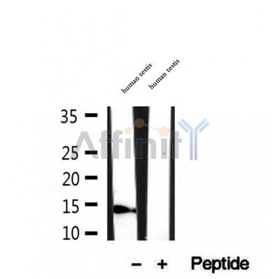 DF12299 at 1/100 staining Human breast cancer tissue by IHC-P. The sample was formaldehyde fixed and a heat mediated antigen retrieval step in citrate buffer was performed. The sample was then blocked and incubated with the antibody for 1.5 hours at 22¡ãC. An HRP conjugated goat anti-rabbit antibody was used as the secondary