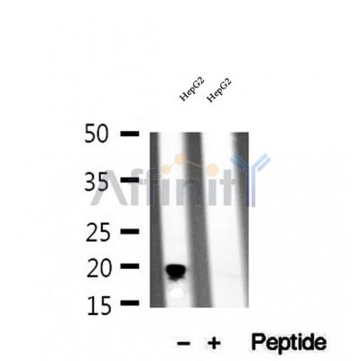 DF12300 at 1/100 staining Human lymph cancer tissue by IHC-P. The sample was formaldehyde fixed and a heat mediated antigen retrieval step in citrate buffer was performed. The sample was then blocked and incubated with the antibody for 1.5 hours at 22¡ãC. An HRP conjugated goat anti-rabbit antibody was used as the secondary