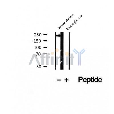 DF12306 at 1/100 staining Human breast cancer tissue by IHC-P. The sample was formaldehyde fixed and a heat mediated antigen retrieval step in citrate buffer was performed. The sample was then blocked and incubated with the antibody for 1.5 hours at 22¡ãC. An HRP conjugated goat anti-rabbit antibody was used as the secondary