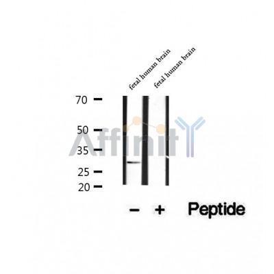 DF12311 at 1/100 staining Human lymph cancer tissue by IHC-P. The sample was formaldehyde fixed and a heat mediated antigen retrieval step in citrate buffer was performed. The sample was then blocked and incubated with the antibody for 1.5 hours at 22¡ãC. An HRP conjugated goat anti-rabbit antibody was used as the secondary