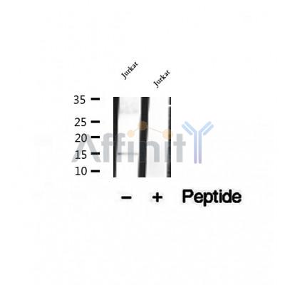 DF12318 at 1/100 staining Human lymph cancer tissue by IHC-P. The sample was formaldehyde fixed and a heat mediated antigen retrieval step in citrate buffer was performed. The sample was then blocked and incubated with the antibody for 1.5 hours at 22¡ãC. An HRP conjugated goat anti-rabbit antibody was used as the secondary