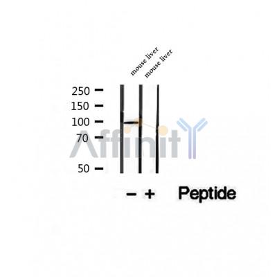 DF12327 at 1/100 staining Human lymph cancer tissue by IHC-P. The sample was formaldehyde fixed and a heat mediated antigen retrieval step in citrate buffer was performed. The sample was then blocked and incubated with the antibody for 1.5 hours at 22¡ãC. An HRP conjugated goat anti-rabbit antibody was used as the secondary