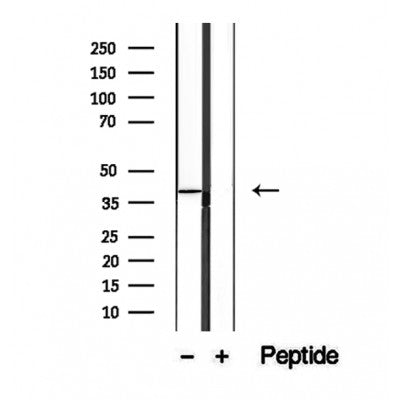 DF12340 at 1/100 staining Human lymph cancer tissue by IHC-P. The sample was formaldehyde fixed and a heat mediated antigen retrieval step in citrate buffer was performed. The sample was then blocked and incubated with the antibody for 1.5 hours at 22¡ãC. An HRP conjugated goat anti-rabbit antibody was used as the secondary