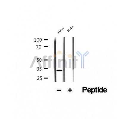 DF12352 at 1/100 staining Human lymph cancer tissue by IHC-P. The sample was formaldehyde fixed and a heat mediated antigen retrieval step in citrate buffer was performed. The sample was then blocked and incubated with the antibody for 1.5 hours at 22¡ãC. An HRP conjugated goat anti-rabbit antibody was used as the secondary