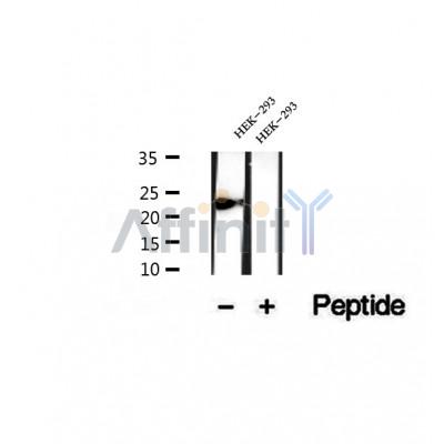 DF12379 at 1/100 staining Human pancreas cancer tissue by IHC-P. The sample was formaldehyde fixed and a heat mediated antigen retrieval step in citrate buffer was performed. The sample was then blocked and incubated with the antibody for 1.5 hours at 22¡ãC. An HRP conjugated goat anti-rabbit antibody was used as the secondary