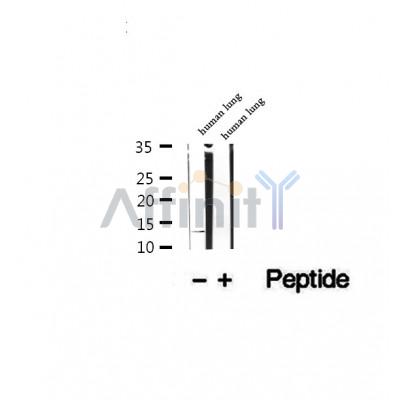 DF12384 at 1/100 staining Human pancreas cancer tissue by IHC-P. The sample was formaldehyde fixed and a heat mediated antigen retrieval step in citrate buffer was performed. The sample was then blocked and incubated with the antibody for 1.5 hours at 22¡ãC. An HRP conjugated goat anti-rabbit antibody was used as the secondary