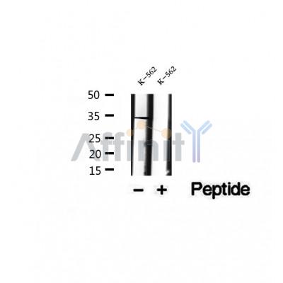 DF12392 at 1/100 staining Human pancreas cancer tissue by IHC-P. The sample was formaldehyde fixed and a heat mediated antigen retrieval step in citrate buffer was performed. The sample was then blocked and incubated with the antibody for 1.5 hours at 22¡ãC. An HRP conjugated goat anti-rabbit antibody was used as the secondary