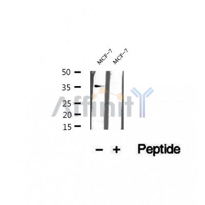 DF12414 at 1/100 staining Human pancreas cancer tissue by IHC-P. The sample was formaldehyde fixed and a heat mediated antigen retrieval step in citrate buffer was performed. The sample was then blocked and incubated with the antibody for 1.5 hours at 22¡ãC. An HRP conjugated goat anti-rabbit antibody was used as the secondary