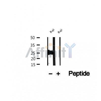 DF12445 at 1/100 staining Human pancreas cancer tissue by IHC-P. The sample was formaldehyde fixed and a heat mediated antigen retrieval step in citrate buffer was performed. The sample was then blocked and incubated with the antibody for 1.5 hours at 22¡ãC. An HRP conjugated goat anti-rabbit antibody was used as the secondary