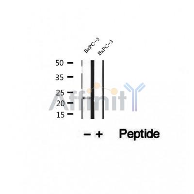 DF12464 at 1/100 staining Human thyroid cancer tissue by IHC-P. The sample was formaldehyde fixed and a heat mediated antigen retrieval step in citrate buffer was performed. The sample was then blocked and incubated with the antibody for 1.5 hours at 22¡ãC. An HRP conjugated goat anti-rabbit antibody was used as the secondary