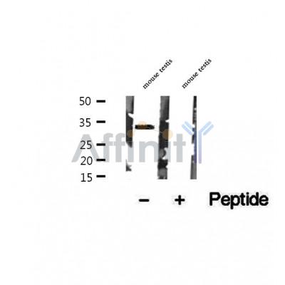 DF12483 at 1/100 staining Human thyroid cancer tissue by IHC-P. The sample was formaldehyde fixed and a heat mediated antigen retrieval step in citrate buffer was performed. The sample was then blocked and incubated with the antibody for 1.5 hours at 22¡ãC. An HRP conjugated goat anti-rabbit antibody was used as the secondary
