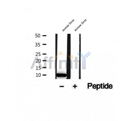 DF12487 at 1/100 staining Human thyroid cancer tissue by IHC-P. The sample was formaldehyde fixed and a heat mediated antigen retrieval step in citrate buffer was performed. The sample was then blocked and incubated with the antibody for 1.5 hours at 22¡ãC. An HRP conjugated goat anti-rabbit antibody was used as the secondary