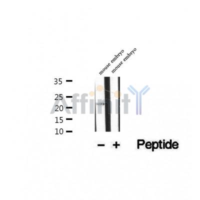 DF12493 at 1/100 staining Human thyroid cancer tissue by IHC-P. The sample was formaldehyde fixed and a heat mediated antigen retrieval step in citrate buffer was performed. The sample was then blocked and incubated with the antibody for 1.5 hours at 22¡ãC. An HRP conjugated goat anti-rabbit antibody was used as the secondary