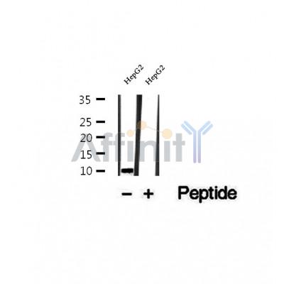 DF12496 at 1/100 staining Human thyroid cancer tissue by IHC-P. The sample was formaldehyde fixed and a heat mediated antigen retrieval step in citrate buffer was performed. The sample was then blocked and incubated with the antibody for 1.5 hours at 22¡ãC. An HRP conjugated goat anti-rabbit antibody was used as the secondary