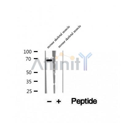 DF12501 at 1/100 staining Human thyroid cancer tissue by IHC-P. The sample was formaldehyde fixed and a heat mediated antigen retrieval step in citrate buffer was performed. The sample was then blocked and incubated with the antibody for 1.5 hours at 22¡ãC. An HRP conjugated goat anti-rabbit antibody was used as the secondary