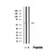 DF12505 at 1/100 staining Human thyroid cancer tissue by IHC-P. The sample was formaldehyde fixed and a heat mediated antigen retrieval step in citrate buffer was performed. The sample was then blocked and incubated with the antibody for 1.5 hours at 22¡ãC. An HRP conjugated goat anti-rabbit antibody was used as the secondary