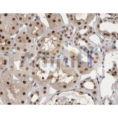 AF0239 at 1/100 staining human kidney carcinoma tissue sections by IHC-P. The tissue was formaldehyde fixed and a heat mediated antigen retrieval step in citrate buffer was performed. The tissue was then blocked and incubated with the antibody for 1.5 hours at 22¡ãC. An HRP conjugated goat anti-rabbit antibody was used as the secondary